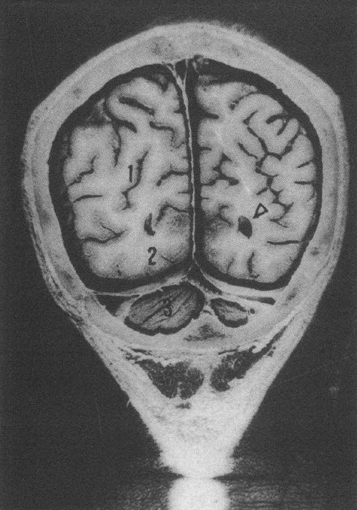 经大脑半球后部冠状切面人体标本图